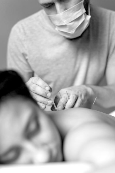 dry needling
